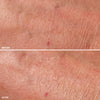 Before-and-after comparison of skin texture and appearance, highlighting reduced redness and improved smoothness.